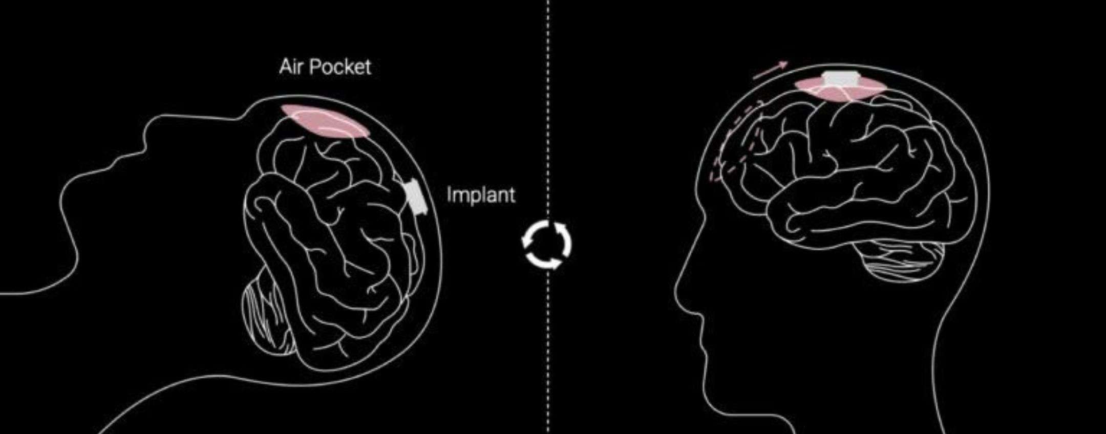 Neuralink, chip modificato per il secondo paziente